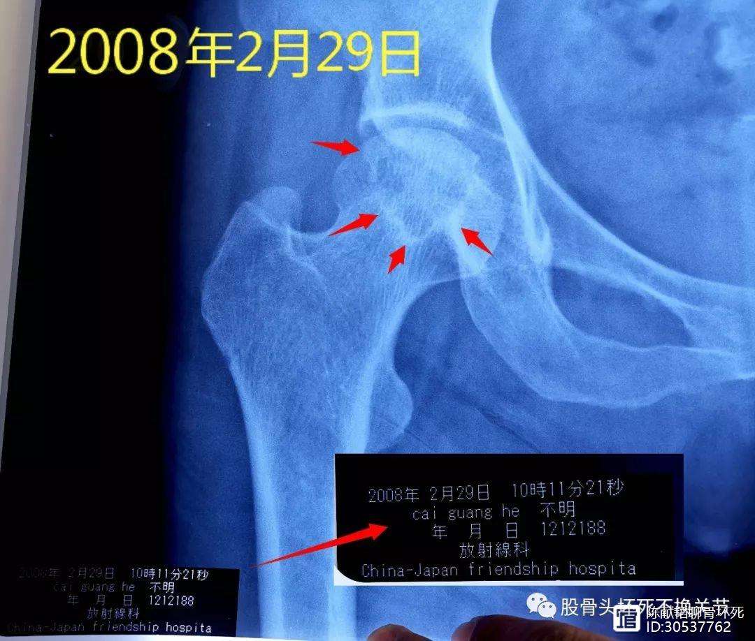 梅州人工骨头医保报销多少(人工骨头医保报销多少比例)